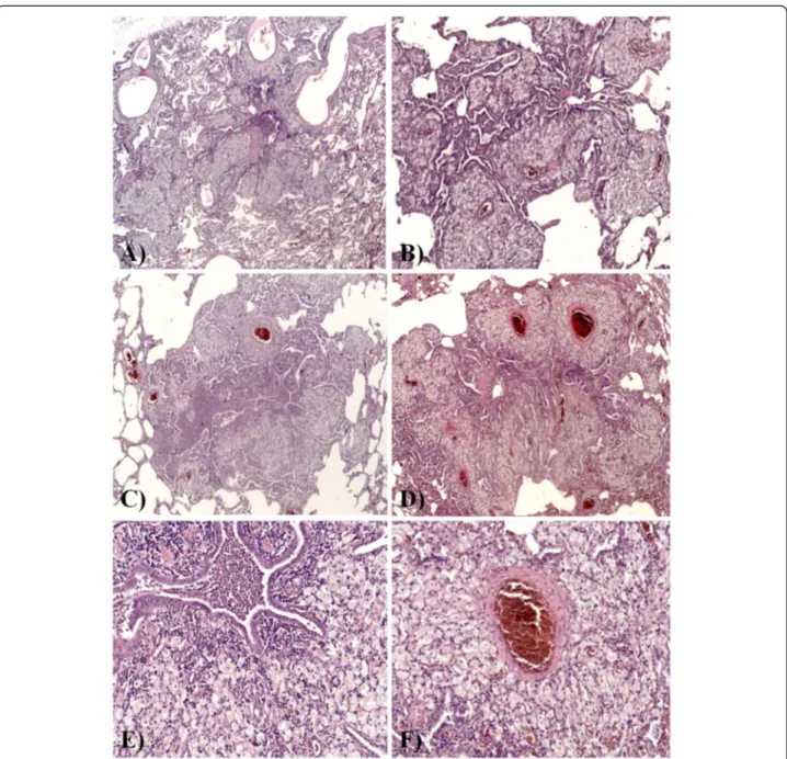 Figure 2 Histological features. (A-D) Transmural and peribronchial infiltration by lymphoctytes and histiocytes was found, with prominent and diffuse involvement of respiratory and terminal bronchioles; most of the histiocytes were foamy macrophages, which