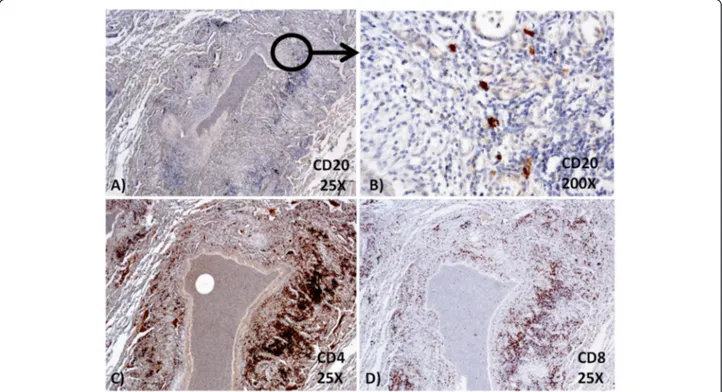Figure 3 Immunohistochemical stains. (A-B) CD20+ B-cells were almost absent in the lymphocytic infiltrate; (C-D) a heterogeneous population of CD4+ and CD8+ T-cells was present.