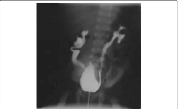 Figure 1 CUM imaging: IV° grade bilateral VUR.