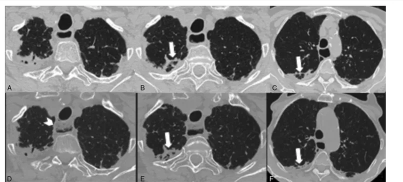 Figure 1. (A–F) PPFE (A–C) in an 80-year-old woman with scleroderma involving the upper lobes and the apical segments of the inferior lobes including the ﬁssures