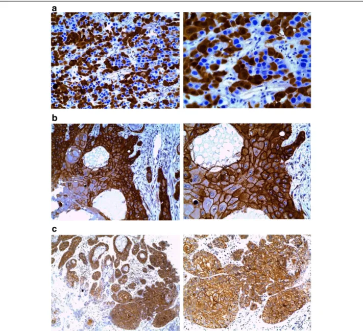 Figure 2 a1 (X20) and a2 (X40). Staining for P16 INK4A in majority of the neoplastic cells showed intense nuclear staining, which reflects the functional role of p16 in control of cell cycle prior to the S-phase
