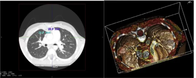 Fig. 2. [a-b-c]: Preoperative CT scan shows the reduction of the retrosternal mass after the “Eudra CT:2008 e ISG AIEOP EW1” protocol