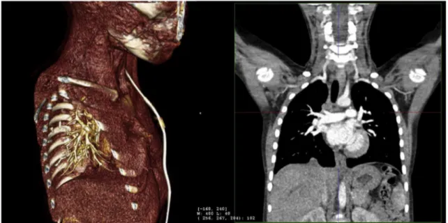 Fig. 5. 3D reconstruction (from CT-scan) after four month from the surgery. It is shown the diaphragmatic mass.