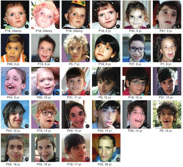 Figure 1 Photographs of patients with Mowat –Wilson syndrome at various ages. The numbered temporal sequence (left to right, top to