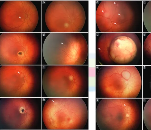 Figure  1: Neonatal retinoblastomas detected through screening of  familial  mutation  carriers