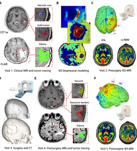 Fig. 1. Experimental design. (A) Patients underwent a clinical MRI to define and characterize the brain tumor, including standard and gadolinium-enhanced T1w [CET1w (contrast-enhanced T1w)], T2w, fluid-attenuated inversion recovery (FLAIR), ASL, and restin