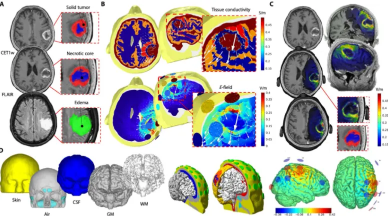 Fig. 2. Tumor tracing, modeling, and optimization. (A) MRI images were manually segmented by two independent investigators