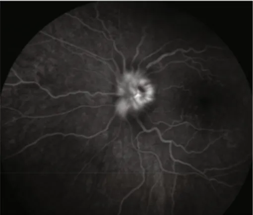 Figure 3: Late-phase angiogram showing leakage from the optic disk of the left eye.