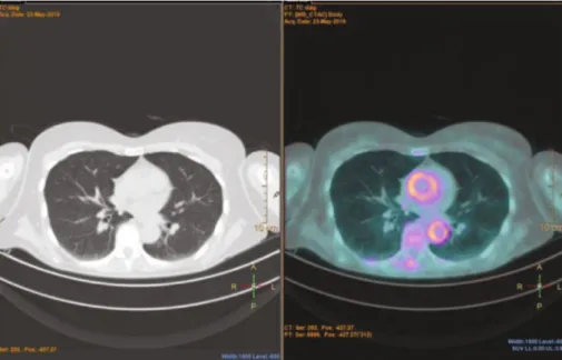 Figure 4: Diﬀuse 18 ﬂuorodeoxyglucose uptake in the territory of thoracic aorta.