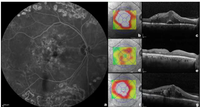 Fig. 1    Left: Fluorescein angiography a of a patient with diabetic  macular oedema before the treatment with dexamethasone  intra-vitreal implants (DEX-I)