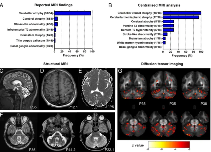 FIGURE 4: Magnetic resonance imaging (MRI) features of coenzyme COQ8A-ataxia. (A) Reported MRI ﬁndings