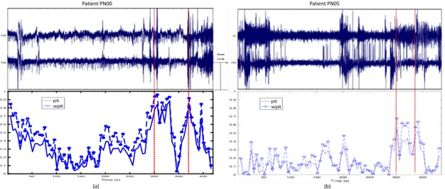 Figure 4. (a) Electroencephalogram (EEG) on channels h = { Fc5 } and k = { Fc6 } ; PLI h,k and WPLI h,k on the 1st seizure of patient PN00