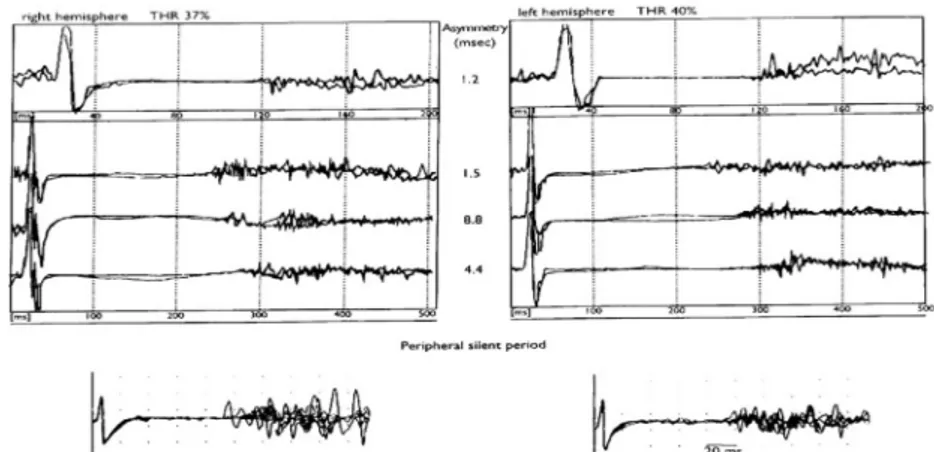 Fig. 6. A representative case of a linear pattern of increase of the CSP duration (right and left hemisphere, recordings from left and right FDI, respectively) as a function of transcranial stimulation intensity which was increased by about 20% from motor 