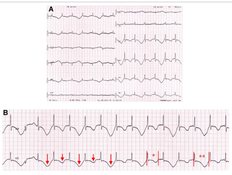 FIGURe 3 | eCG findings on patient 3 on admission. (a,B) T-wave alternans with marked QTc prolongation, ranging from 690 to 870 ms