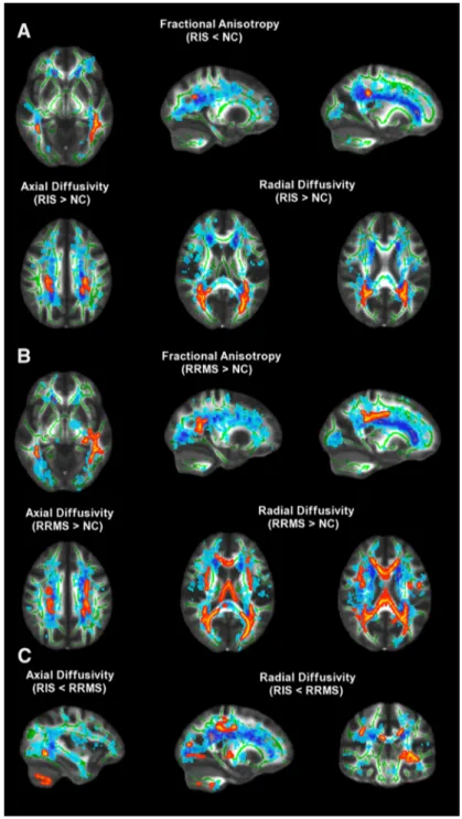 Figure 2. TBSS analysis of DTI measures across the whole brain. Red-yellow shows clusters where RIS subjects (A) and RRMS