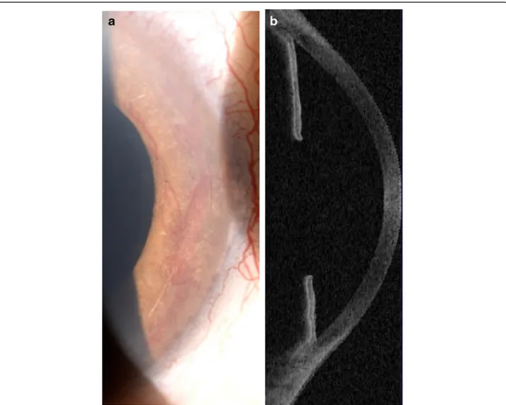 Fig. 1 Biomicroscopic (a) and OCT (b) images of anterior chamber showing angle closure due to neovascularization of the angle