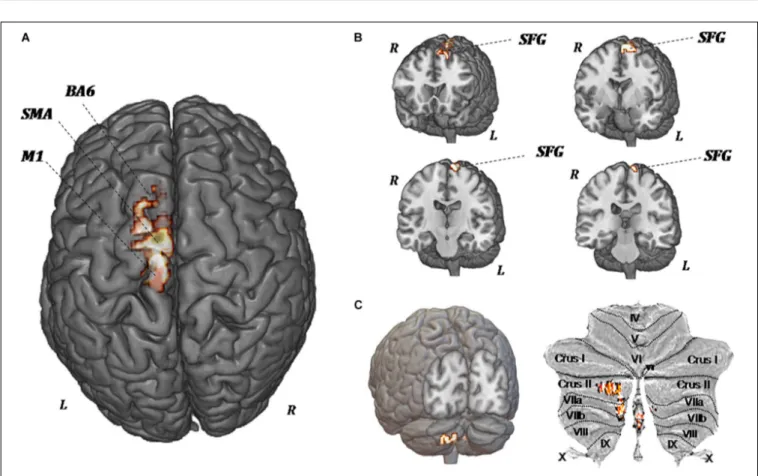 FIGURE 5 | MR perfusion maps demonstrate pre-forced exercise vs. post-forced exercise cerebral blood (CBF) flow changes