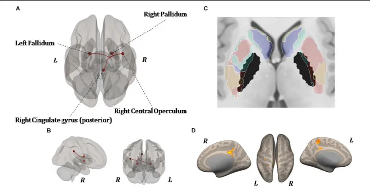 FIGURE 6 | Resting-state functional connectivity differences. Functional image processing and statistical analyses demonstrated increased cortico-subcortical connectivity with respect to pretraining stage