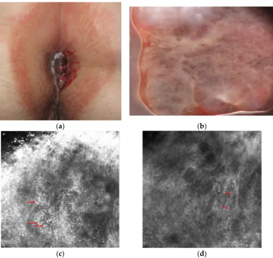 Figure 1. Clinical (a), dermoscopic (b) and RCM (c,d) aspect of a hypomelanotic mucosal mela-