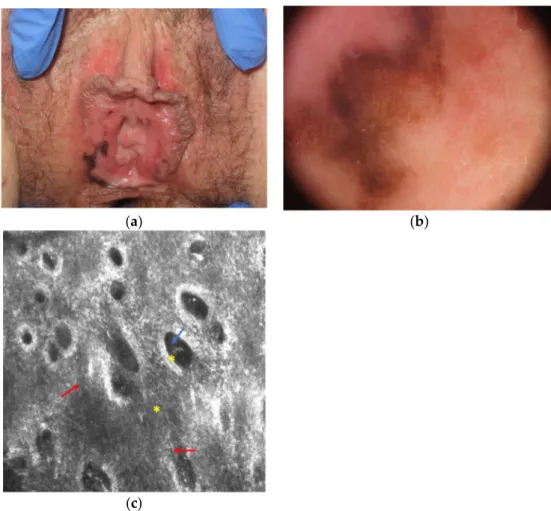 Figure 2. Melanotic macule that is difficult to differentiate from melanoma at clinical (a), dermo-