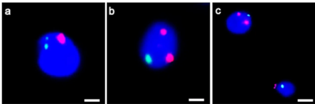 Fig. 5 UV micrographs of the patient ’s spermatozoa hybridized with probes for chromosome 18 (green) and 9 (red)