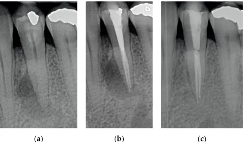 Figure 1. (a) Upper central incisor with periapical lesion. (b) The root after being endodontically treated
