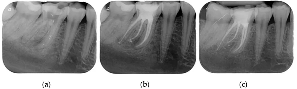 Figure 2. (a) A lower bicuspid in need to be endodontically treated because of necrosis of the pulp  and periapical lesion; (b) The tooth after being endodontically treated