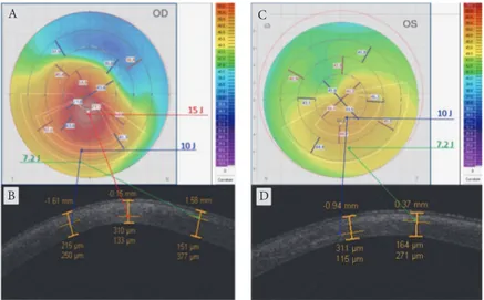 Figure 5: Topography-guided ACXL treatment programs according to different KC severity