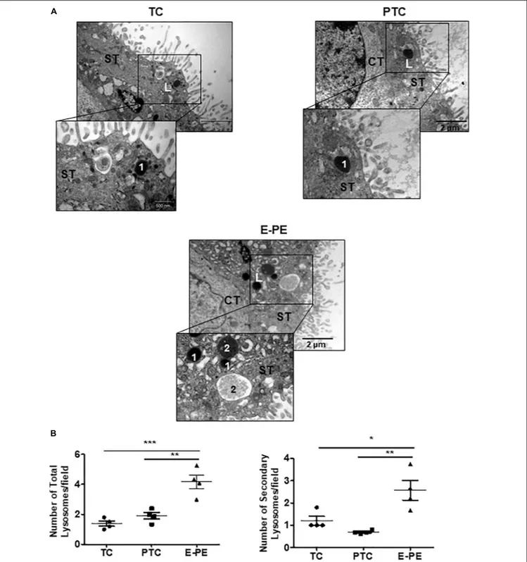 FIGURE 1 | Lysosome morphology in E-PE and control placentae. (A) Representative TEM images of syncytiotrophoblast cells from TC, PTC and PE placental sections