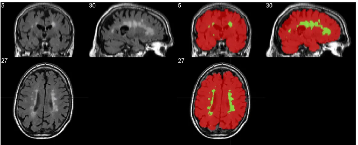 Figure 4 – Left: T2 Flair showing similar intensity between WMH and skin. Right: mask of the  extracted brain in red, with WMH segmentation in green