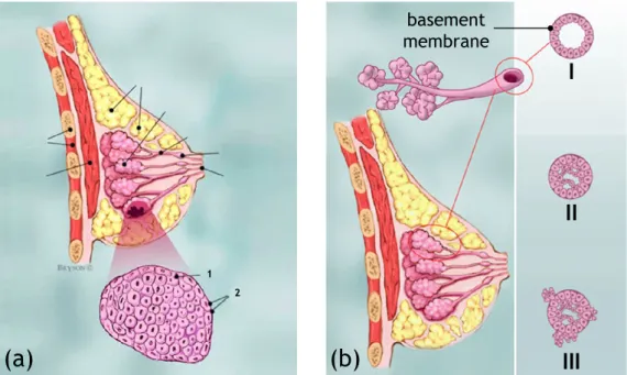 Figure 1.2: (a) Lobular Carcinoma In Situ (LCIS): (1) normal lobular cells, (2) lobular cancer cells