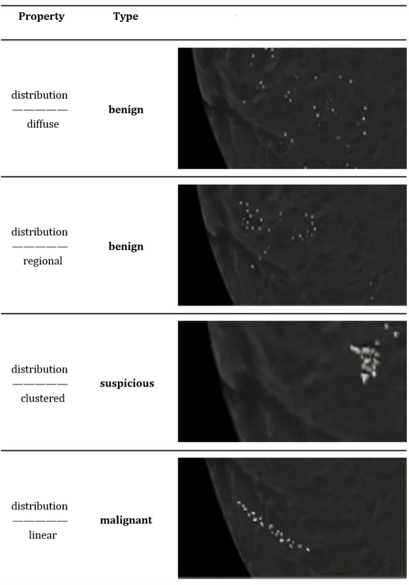 Figure 1.6: Classification of breast calcifications into benign, suspicious and malignant types basing on their distribution
