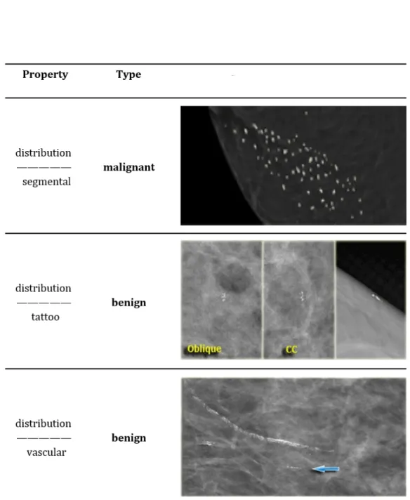 Figure 1.7: Classification of breast calcifications into benign, suspicious and malignant types basing on their distribution