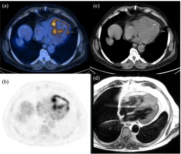 Figure 2. 18 F-fluorodeoxyglucose positron emission tomography/computed tomography images of a 74-year-