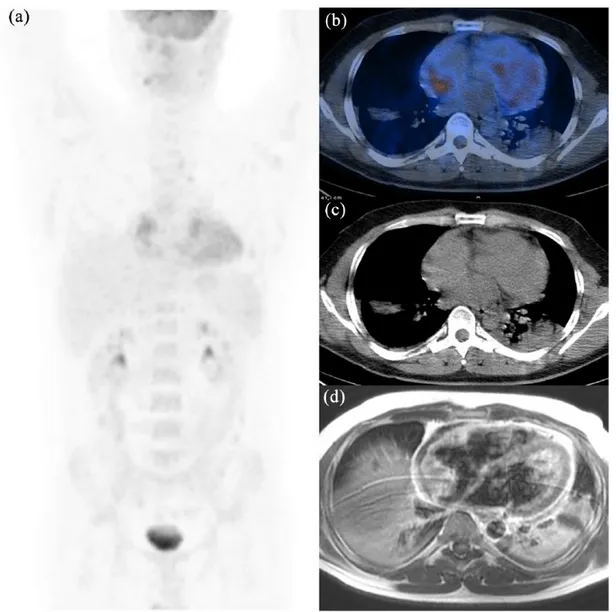 Figure 3. 18 F-fluorodeoxyglucose positron emission tomography/computed tomography images of a 38-year-