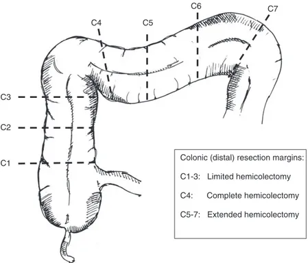 Figure 1 A screen shot of the figure used in the data collection process to map the extent of resection: I, the proximal resection margin; C, the distal resection margin.