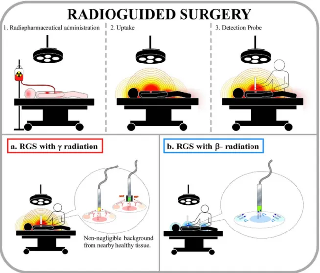 Figure 1 | The radioguided surgery technique (RGS). Steps of the procedure: (1) a radio-labelled tracer is administered to the patient, before the surgery; (2) the emitting tracer is preferentially taken up by the tumour; (3) after the cancerous bulk remov