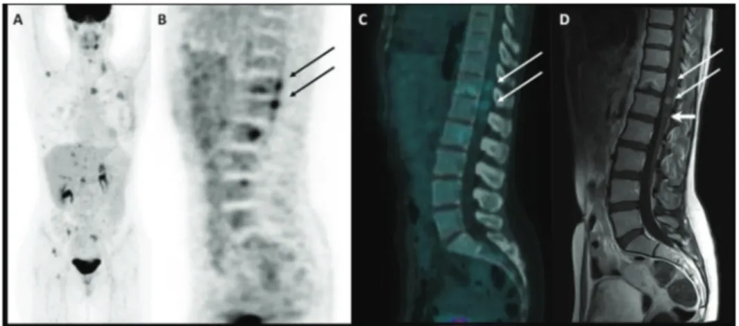 Figure 1: Maximum intensity projection image of 18F-FDG PET/CT scan (A); PET, CT, and MRI sagittal images of spinal cord metastases   (B, C, and D respectively).