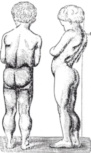 Figura originale di Duchenne (caso n. 68 pubblicato nel 1861). Si noti la lordosi e l’ipertrofia dei polpacci; in tratteggio, sulla de- de-stra, l’asse del corpo