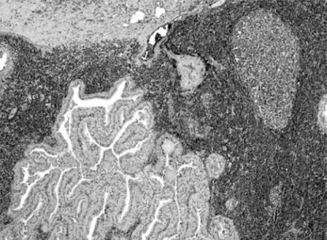 Fig. 3. The nasopharyngeal lesion shows the same histological pattern of  Warthin’s tumour