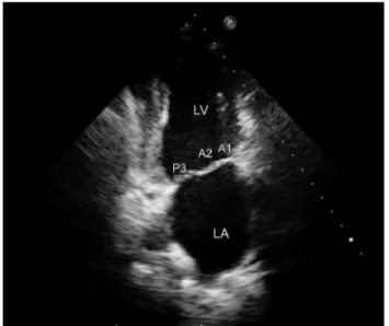 Fig. 2. Parasternal short axis view by transthoracic echocardiography.  Segmental analysis of the mitral valve