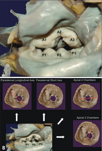 Fig. 5. Surgical view of the mitral valve (A). Spatial orientation of the most  commonly used two-dimensional transthoracic echocardiographic  views (B)