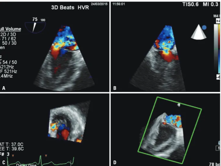 Fig. 7. Multiplanar reconstruction of mitral valve regurgitation using 3-dimensional (3-D) color Doppler full-volume acquisition by transesophageal  echocardiography