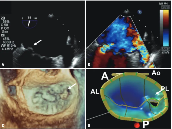 Fig. 8. A and B: Multiplane 2-dimensional transesophageal echocardiogram showing commissural view without (A) and with (B) color Doppler