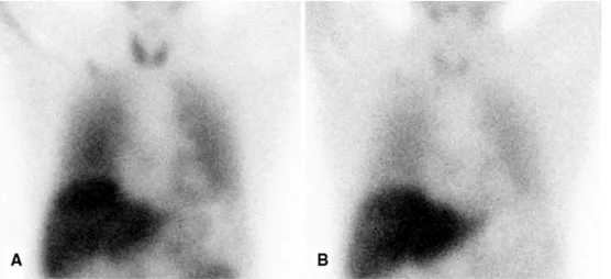 Fig. 2 Abnormal [ 123 I]-MIBG scintigraphy in a patient with ATTR amyloidosis. a Early image acquired after 15 min after tracer administration, b late image acquired after 4 h post injection.