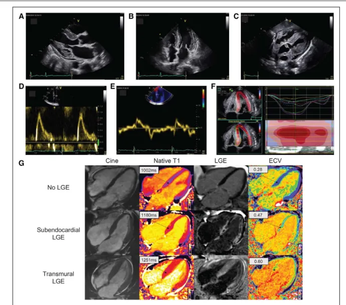 Figure 3.  Typical echocardiography and cardiac magnetic resonance (CMR) findings in a patient with cardiac amyloidosis
