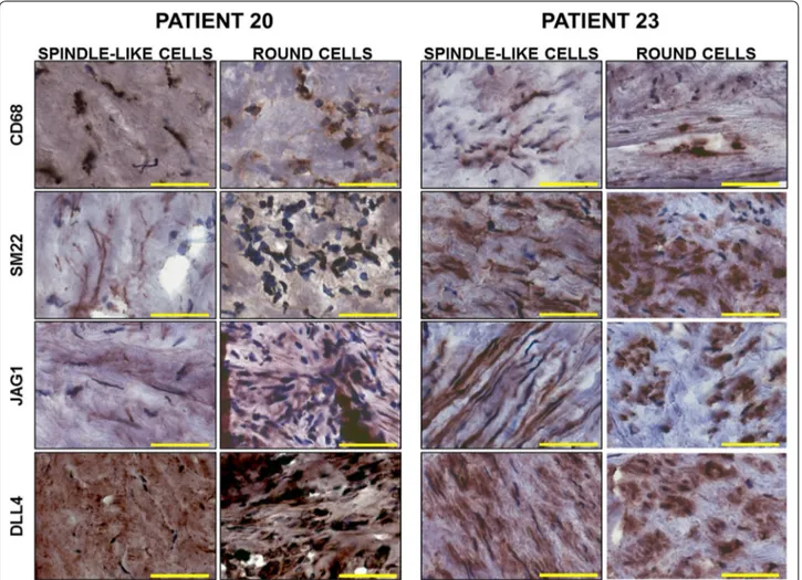Fig. 5  Immunostaining for CD68, αSMA, Jag1 and Dll4 in patients with stable or inflammatory plaque profile