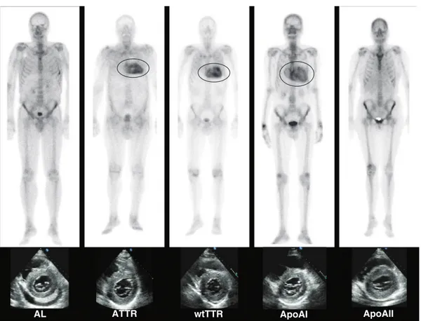 FIGURE 1. The role of 99m Tc-DPD ( 99m Tc-3,3-diphosphono-1,2-propanodicarboxylic acid) scintigraphy in the diagnosis of