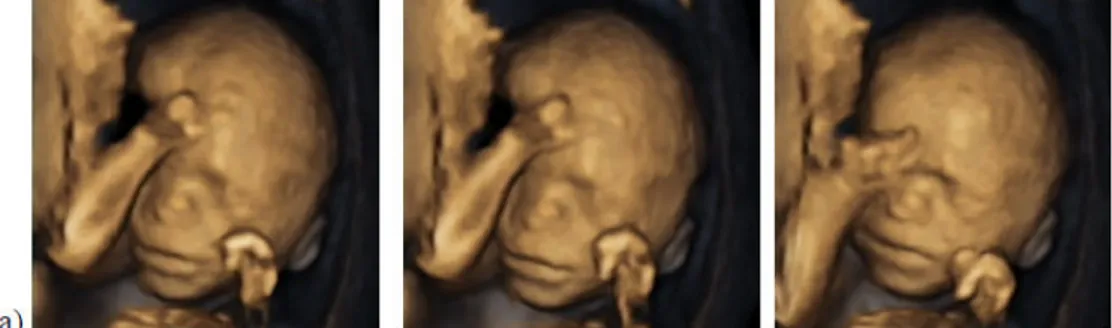 Figura  3.1.  Sequenza  di  azioni  facciali  osservate  in  un  feto  di  20  settimane  (a),  di  26  settimane (b) e di 28 settimane (c) di età gestazionale