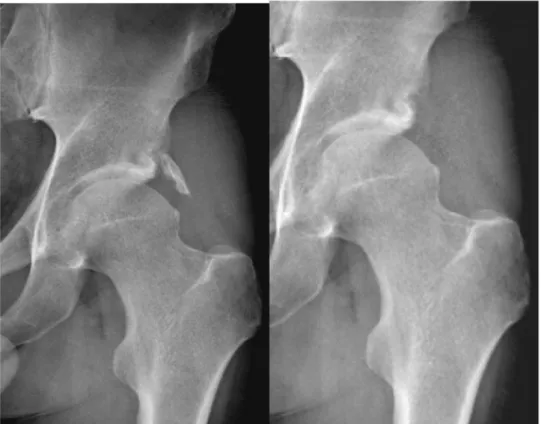 Fig. 1 and 2. Image showing ossiﬁcation of the rectus femoris. Post-op x-ray showing complete excision of the PHO.